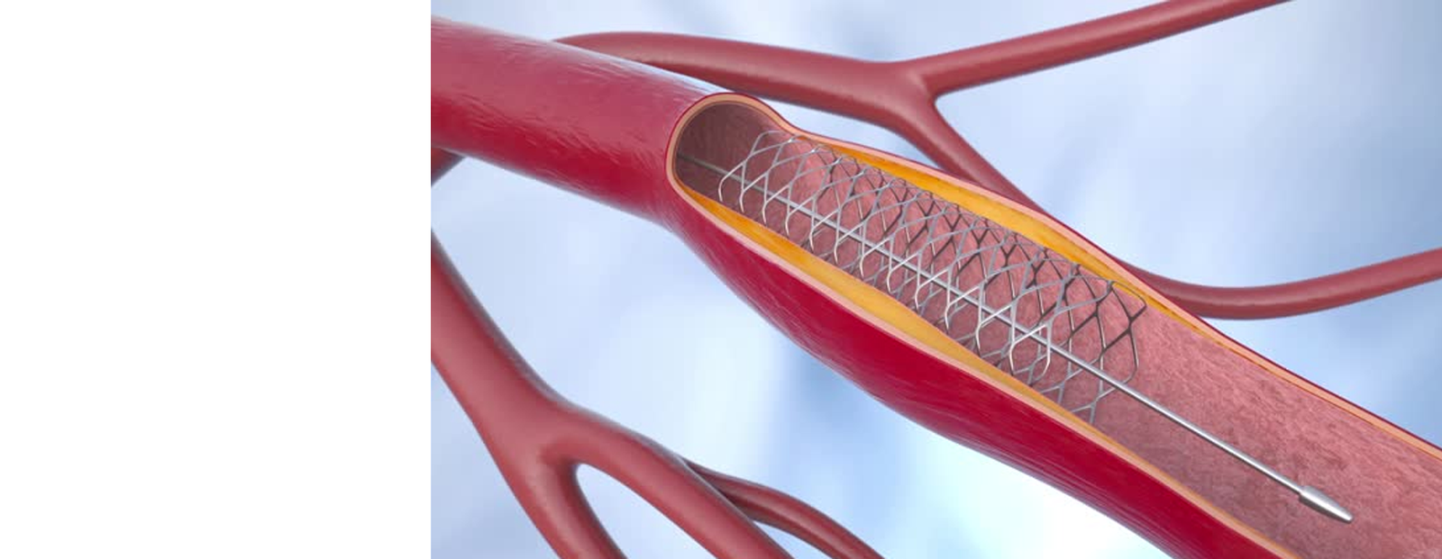 Medical illustration of angioplasty procedure